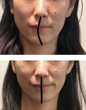 痛くないコルギで顔の歪みを治したい