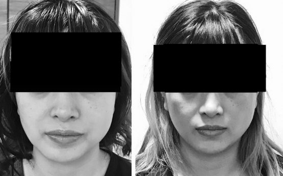 小顔矯正 効果 期間 コルギ 日本のコルギ創始 日本骨気協会