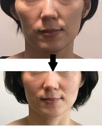 コルギは小顔矯正法の一つです 小顔矯正 コルギ 日本骨気協会 林幸千代のプレミアムコルギ